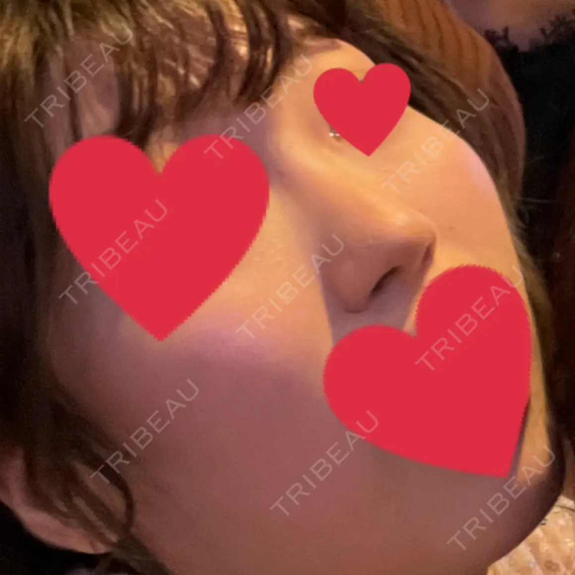 隆鼻術 / 鼻尖形成（切開） / 小鼻縮小（切開） / 軟骨移植 グローバルビューティークリニック 大阪院 AFTER