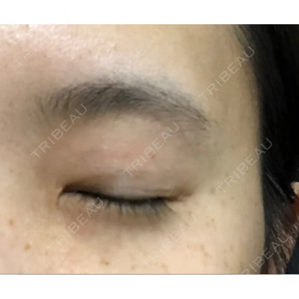 二重埋没 銀座高須クリニック AFTER