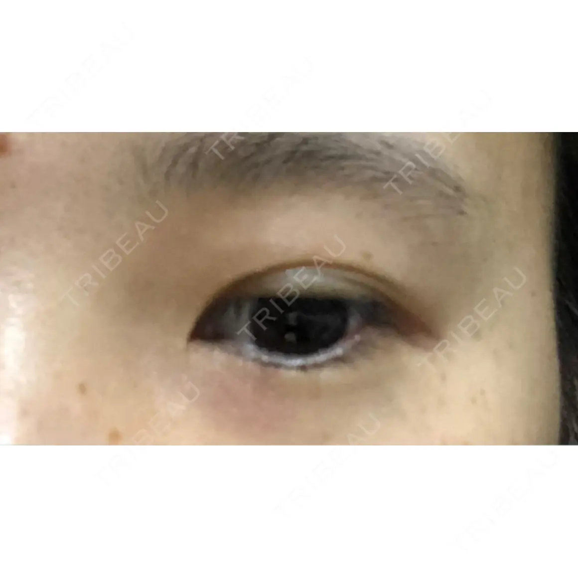二重埋没 銀座高須クリニック AFTER