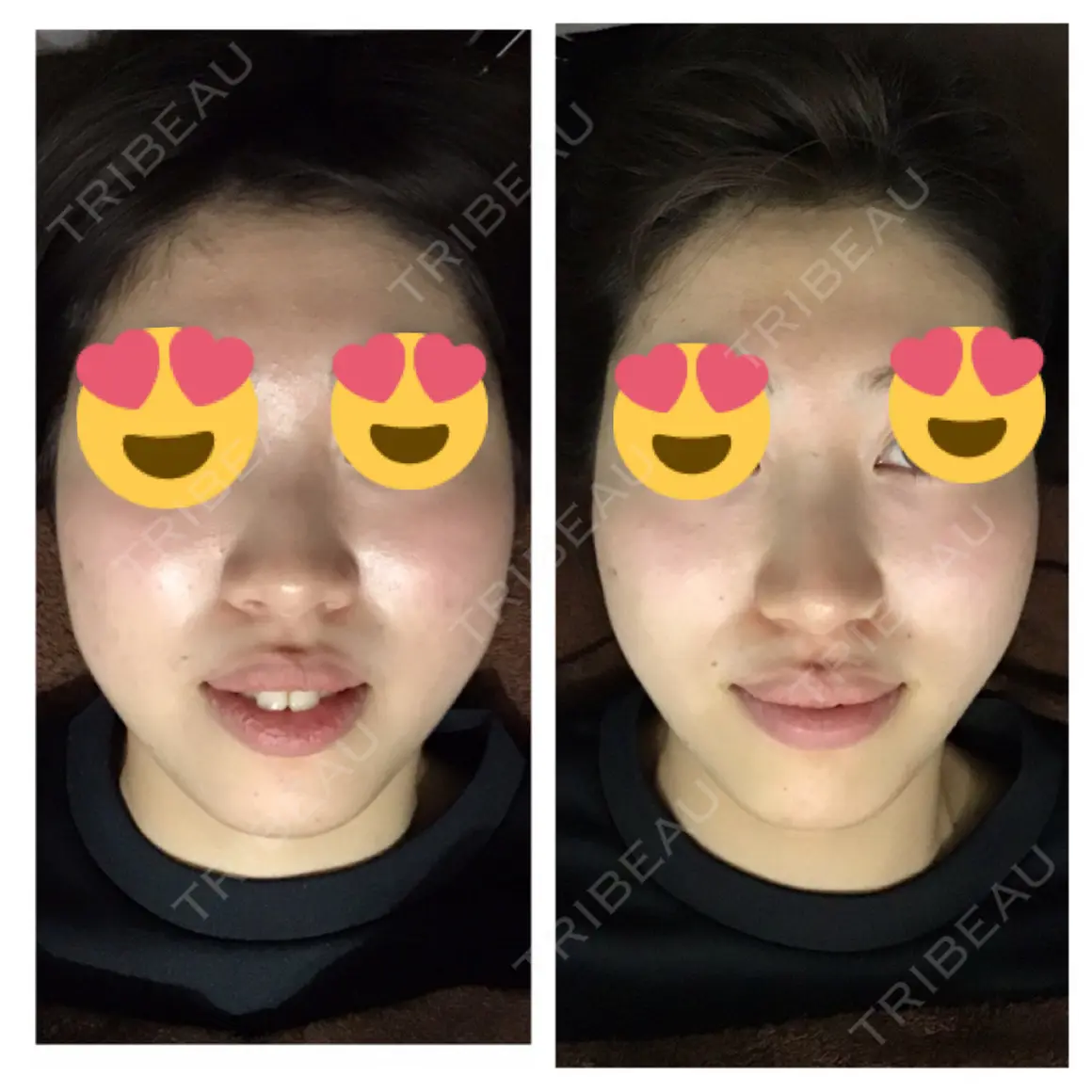 隆鼻術 / 鼻尖形成（切開） / 小鼻縮小（切開） / 軟骨移植 グローバルビューティークリニック 大阪院 AFTER