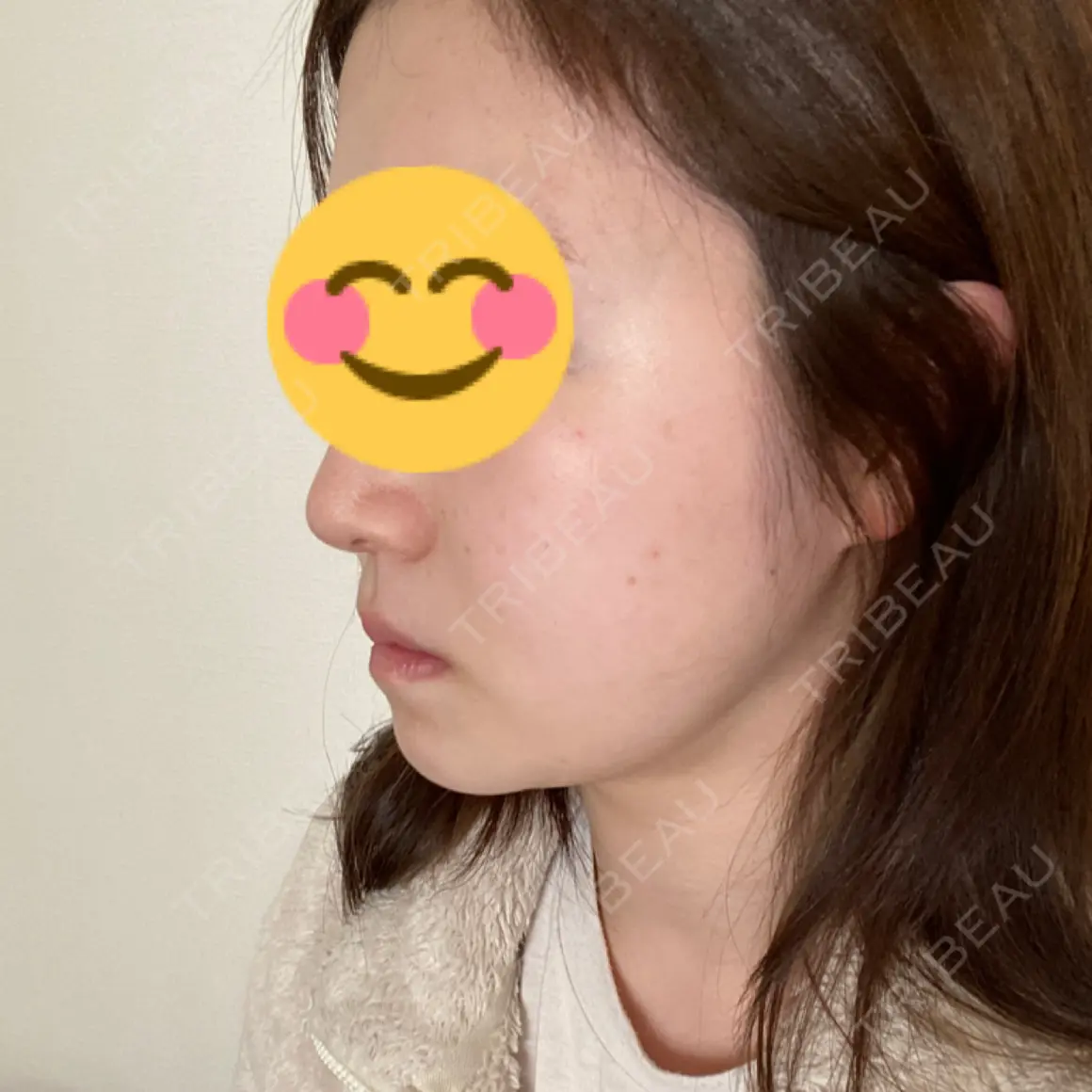 ルメッカ La Clinique Shinjuku 【ラクリニック 新宿】 AFTER