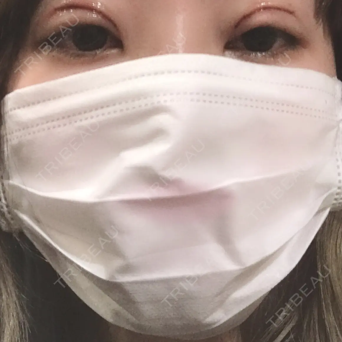 二重切開 / 眼瞼下垂（切開） みやび形成外科 DAY 0