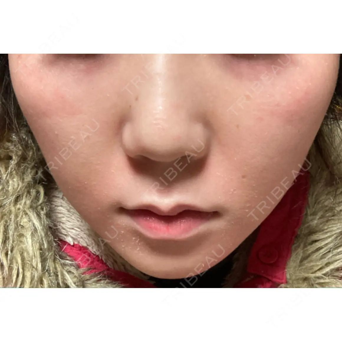 脂肪吸引（顔） くさのたろうクリニック AFTER