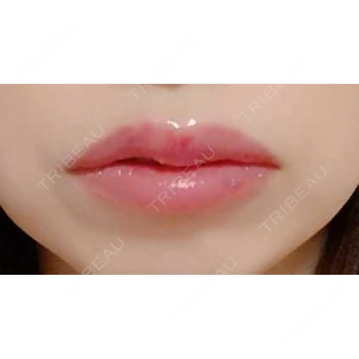 ヒアルロン酸注入（唇） 湘南美容クリニック 小倉院 DAY 0
