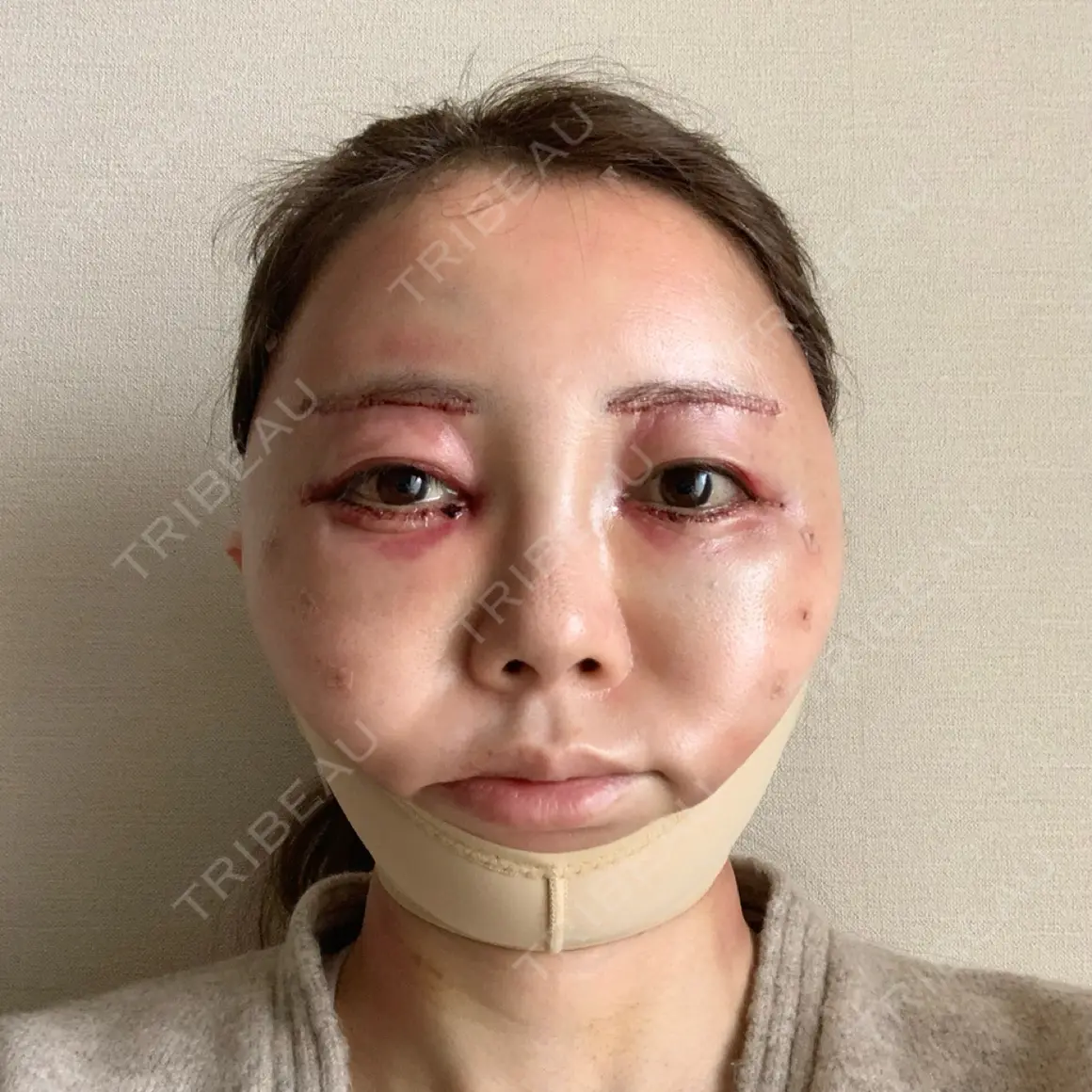糸リフト / 脂肪吸引（顔） / 下まぶたたるみ取り / 眉下切開 / 脂肪注入（額） / 脂肪注入（輪郭） e:Top clinic（イートップクリニック） DAY 1