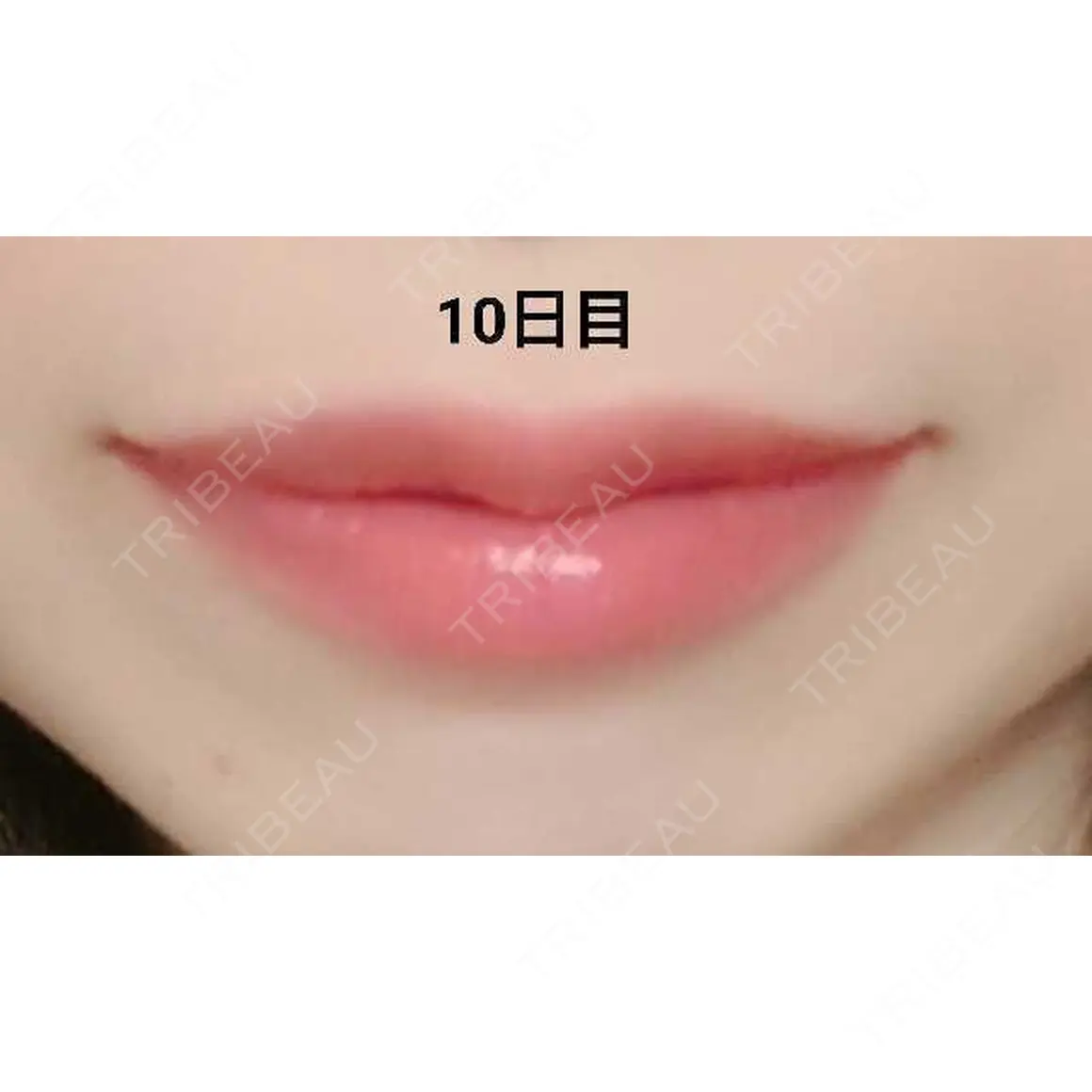 ヒアルロン酸注入（唇） 湘南美容クリニック 小倉院 AFTER