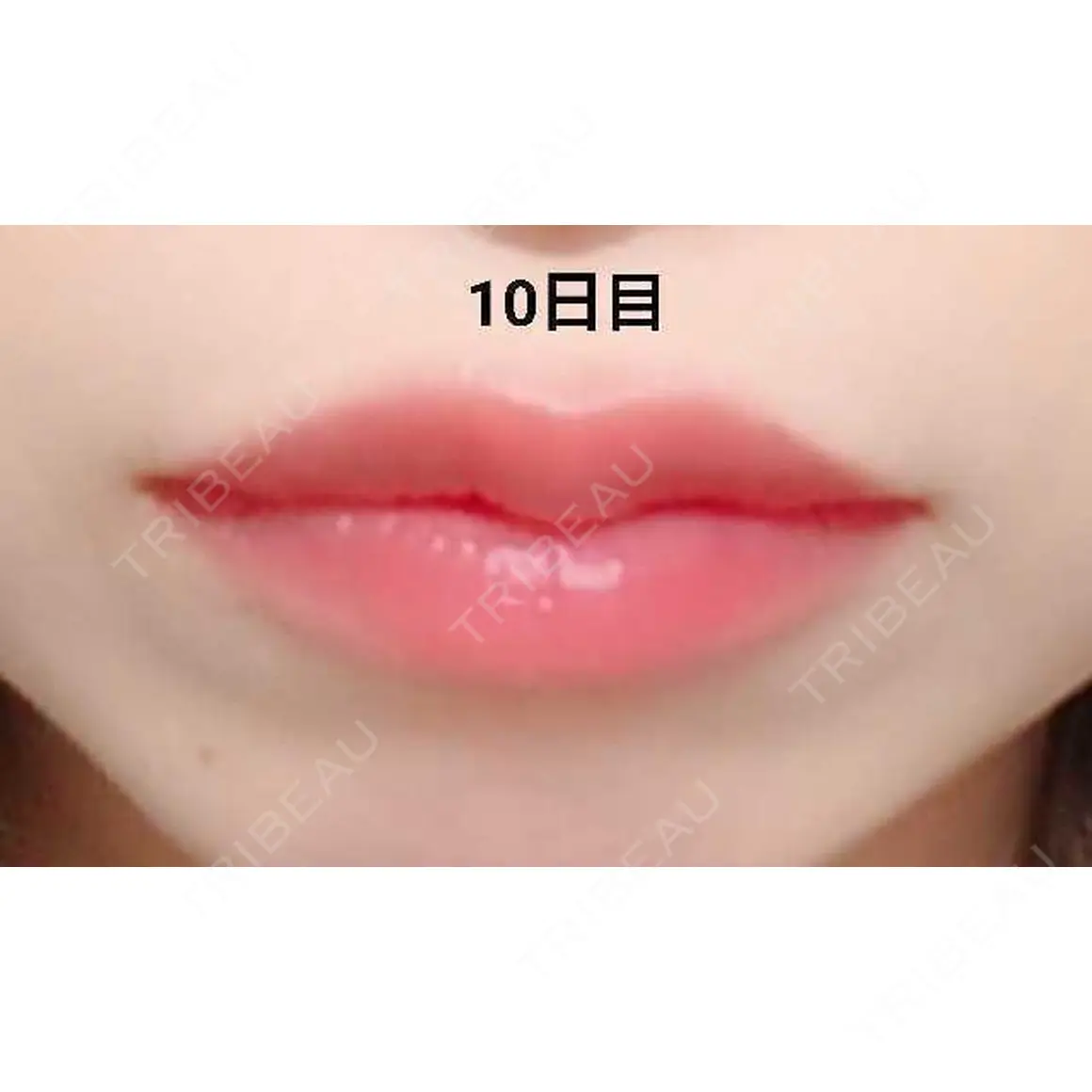 ヒアルロン酸注入（唇） 湘南美容クリニック 小倉院 AFTER