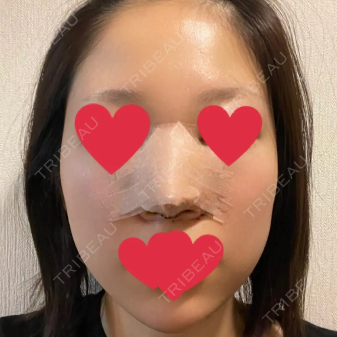 鼻尖形成（切開） / 鼻中隔延長（切開） / 眉間プロテーゼ / その他（鼻） MIL CLINIC OSAKA DAY 1