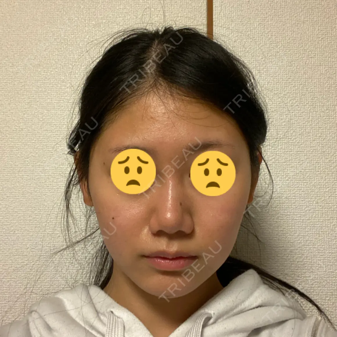 ヒアルロン酸注入（鼻） / ヒアルロン酸注入（あご） アクトリー勝どきウェルネスメディカルクリニック DAY 0