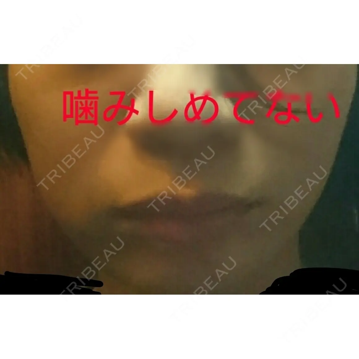 ボトックス（エラ・小顔） 湘南美容クリニック 新宿南口院 AFTER