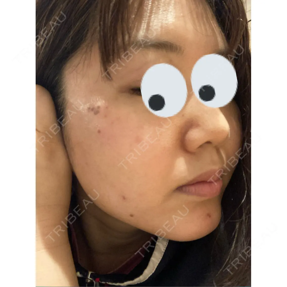 シミ取りレーザー / 光治療（フォトフェイシャルなど） 渋谷美容外科クリニック 新橋院 DAY 0