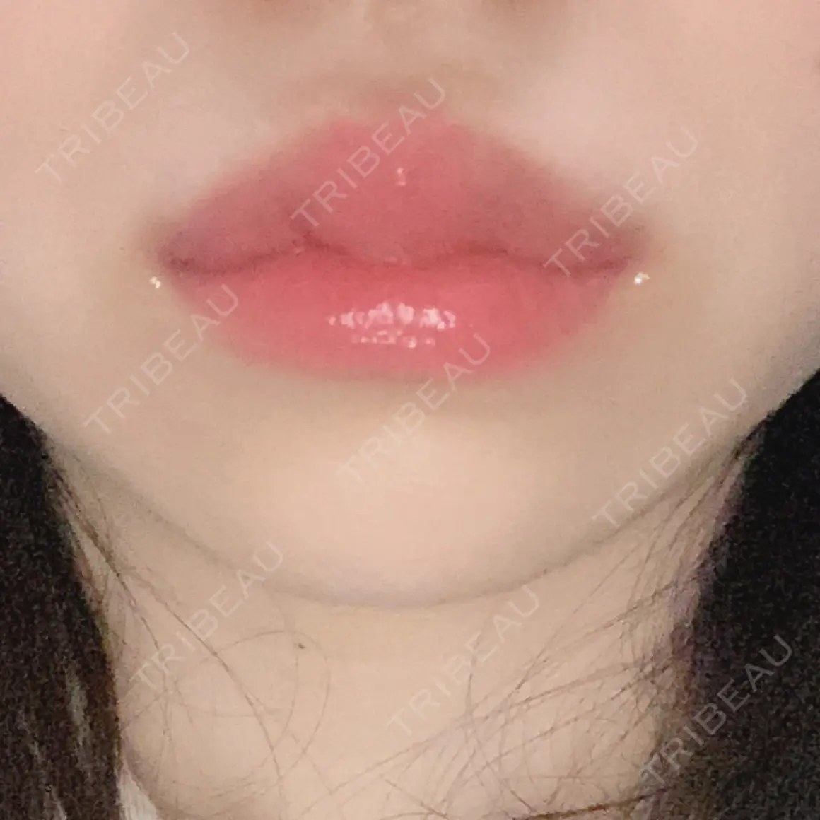 ヒアルロン酸注入（唇） / ボトックス（口角） id美容クリニック 銀座院 DAY 0