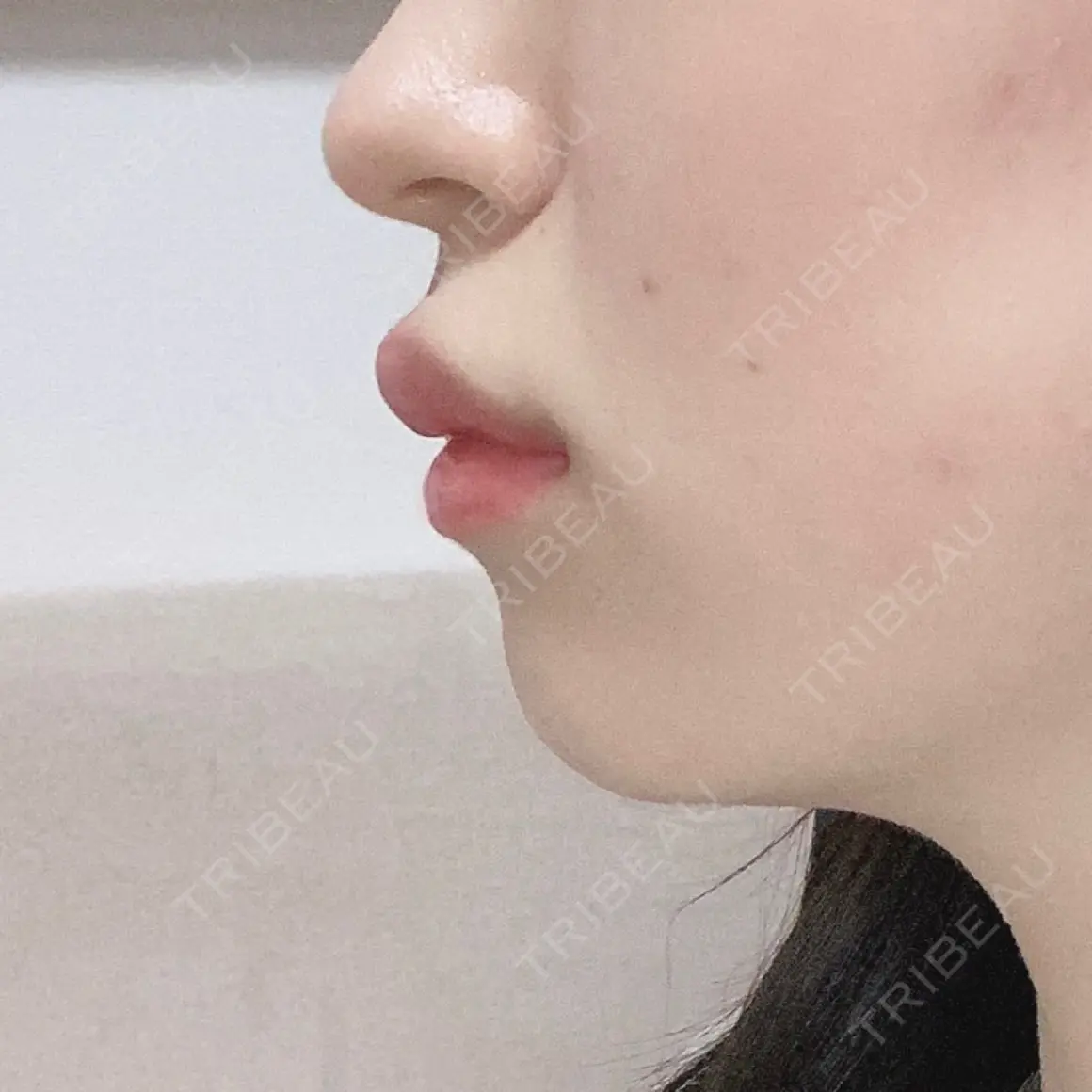 ヒアルロン酸注入（唇） / ボトックス（口角） id美容クリニック 銀座院 AFTER