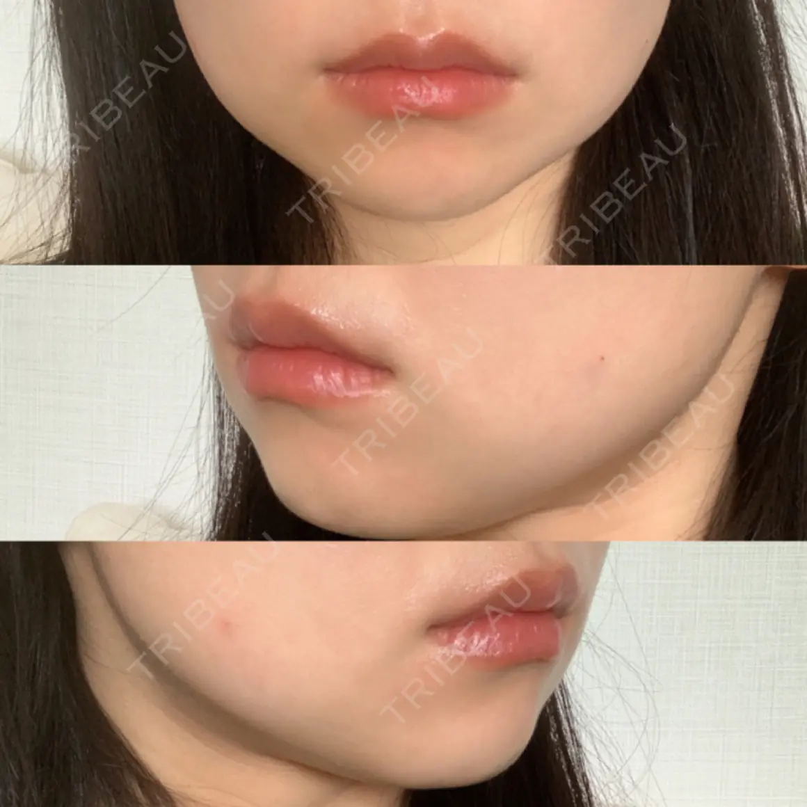ボトックス（エラ・小顔） / 脂肪溶解注射（顔） id美容クリニック 銀座院 DAY 0