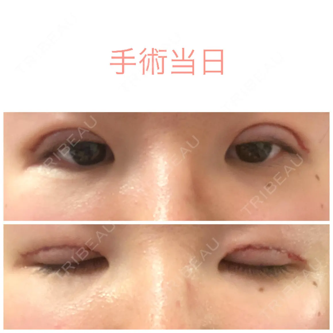 二重切開 / 上まぶたの脂肪取り 聖心美容クリニック 札幌院 DAY 0