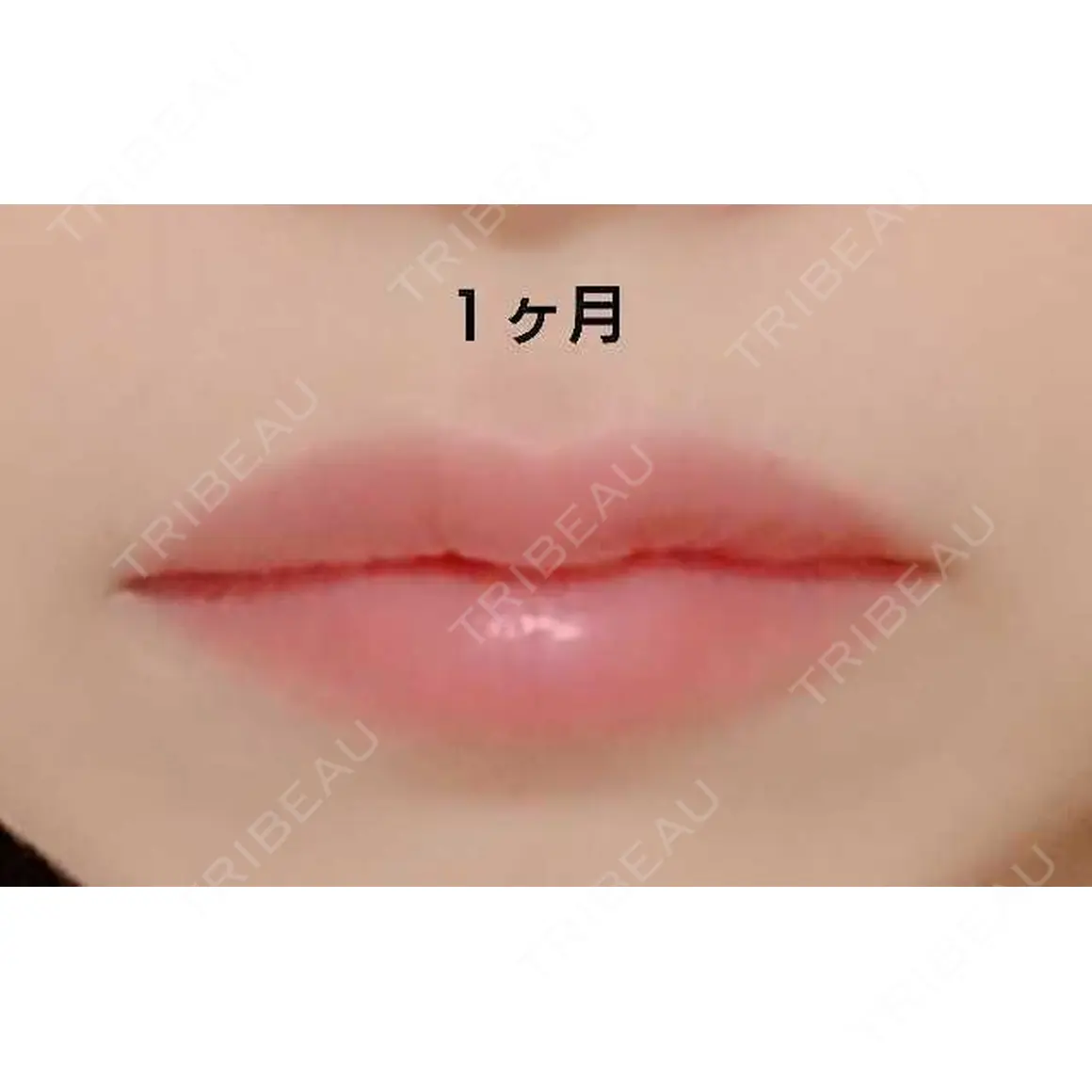 ヒアルロン酸注入（唇） 湘南美容クリニック 小倉院 AFTER