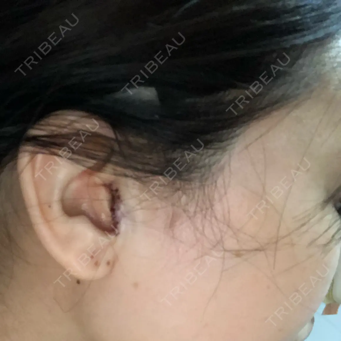 鼻尖形成（切開） / 軟骨移植 高崎美容クリニック DAY 0