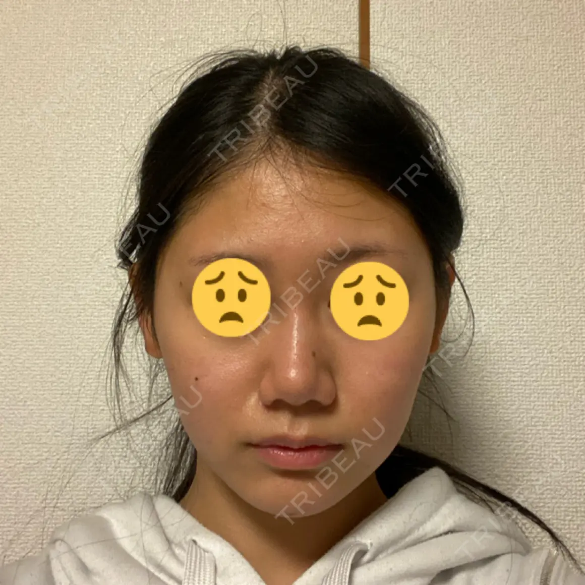 ヒアルロン酸注入（あご） アクトリー勝どきウェルネスメディカルクリニック DAY 0