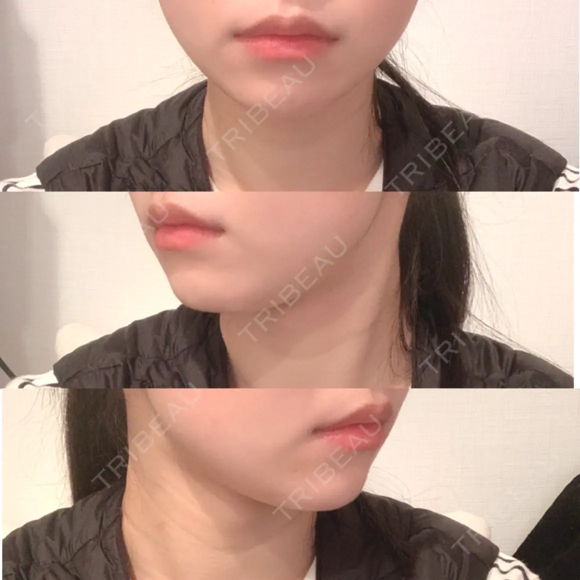 ボトックス（エラ・小顔） / 脂肪溶解注射（顔） id美容クリニック 銀座院 AFTER