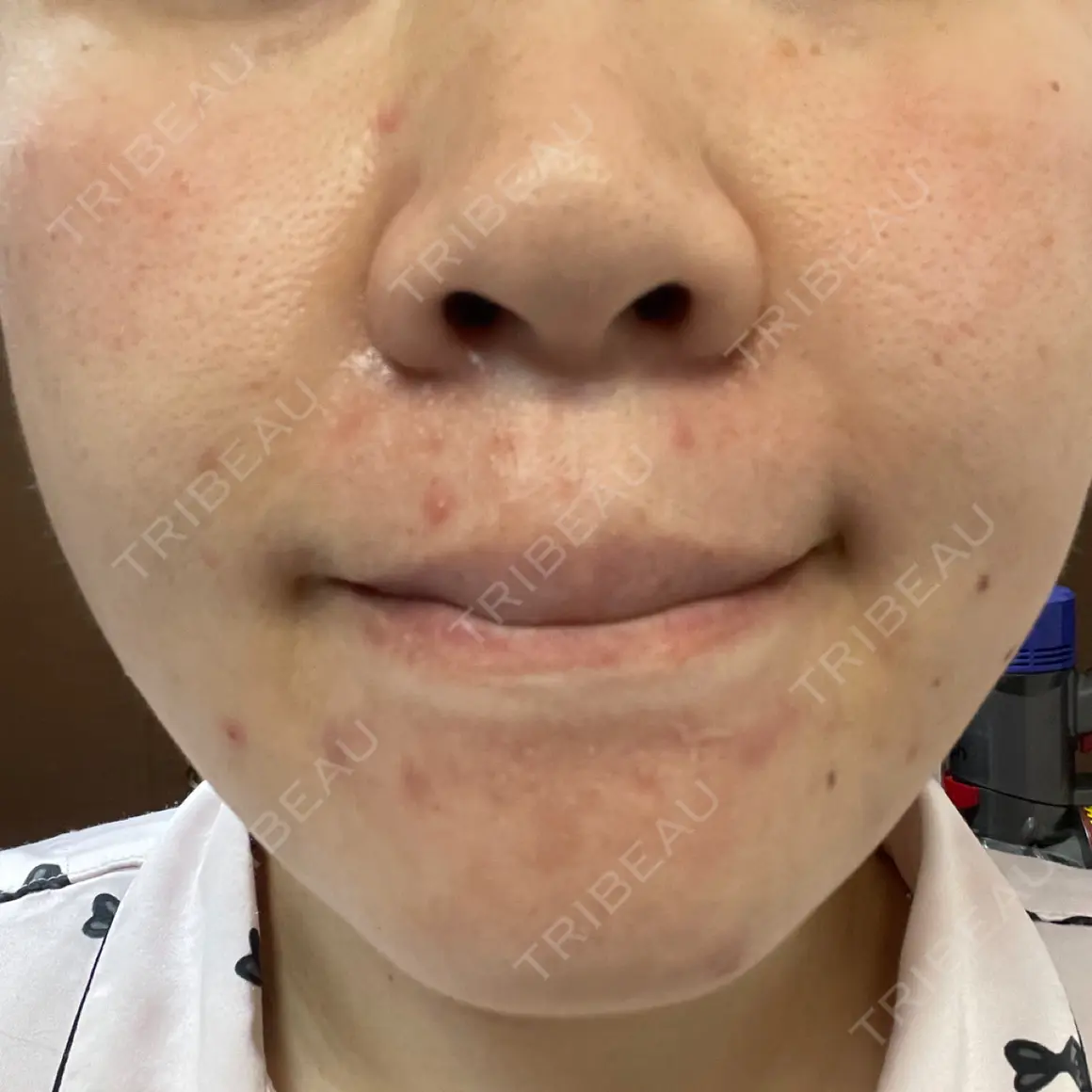 ダーマペン y's clinic  AFTER