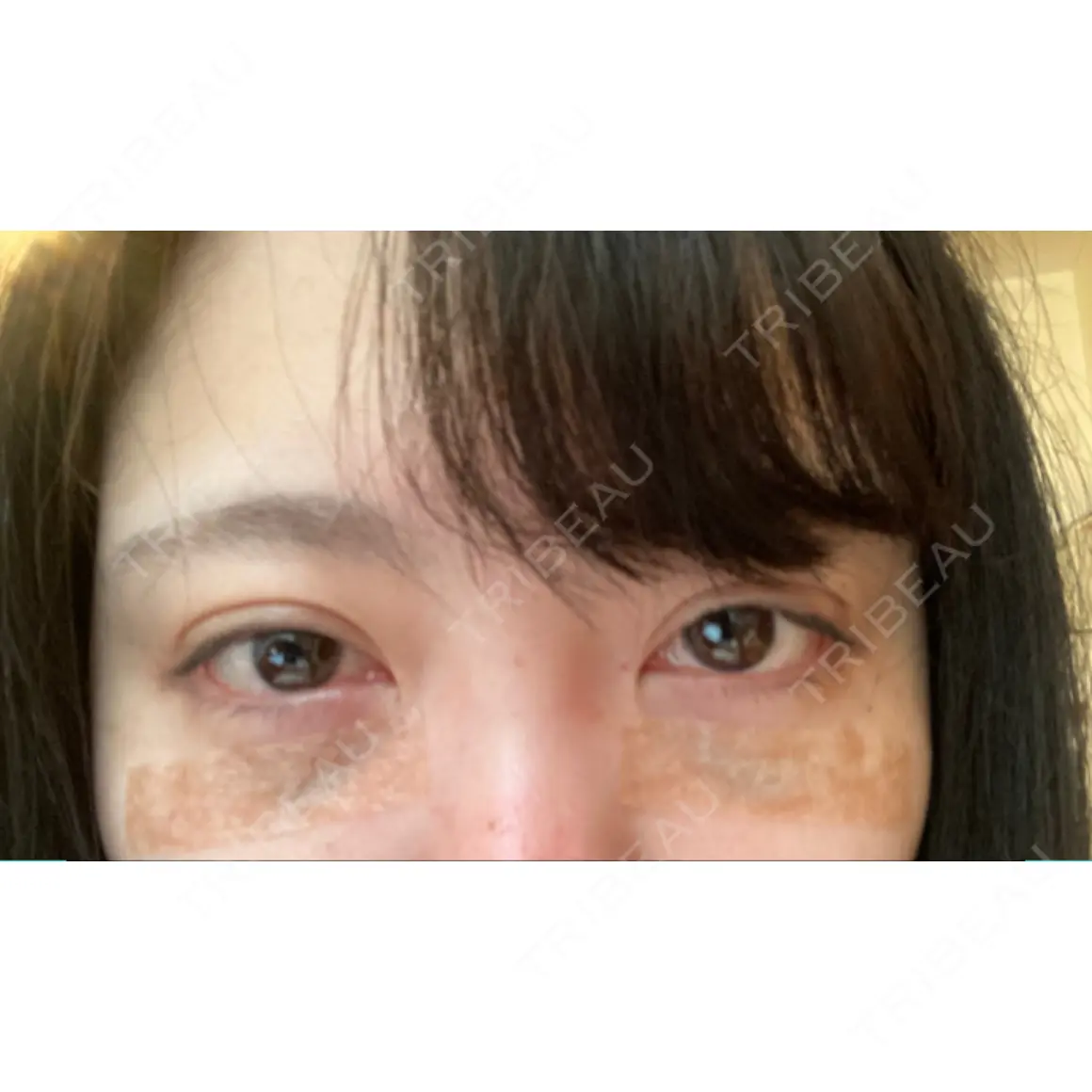 下まぶたの脂肪取り 東京イセアクリニック DAY 0