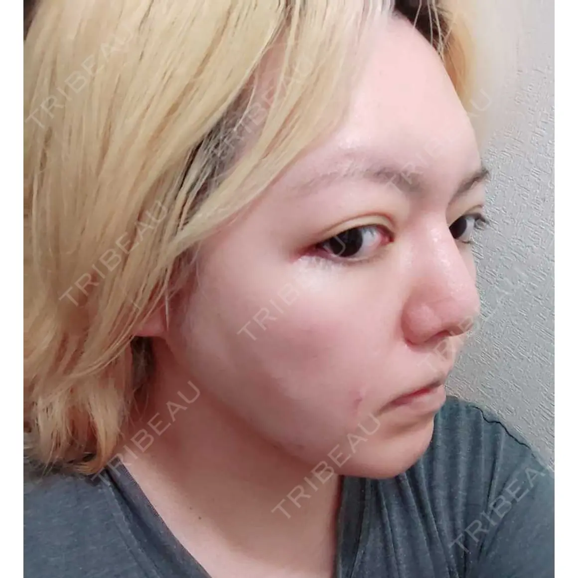 隆鼻術 / スレッドノーズ / その他（鼻） 品川美容外科 新宿院（※品川スキンクリニック提携） AFTER
