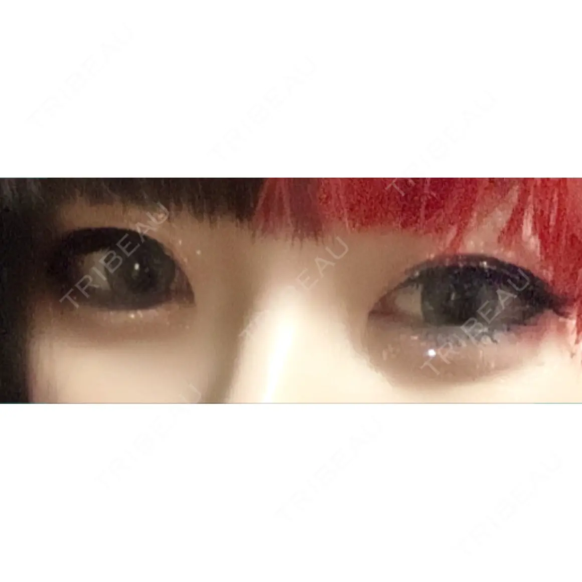 下まぶたの脂肪取り / 美容点滴・美容注射（美肌） / ヒアルロン酸溶解 品川美容外科 渋谷院（※品川スキンクリニック提携） AFTER
