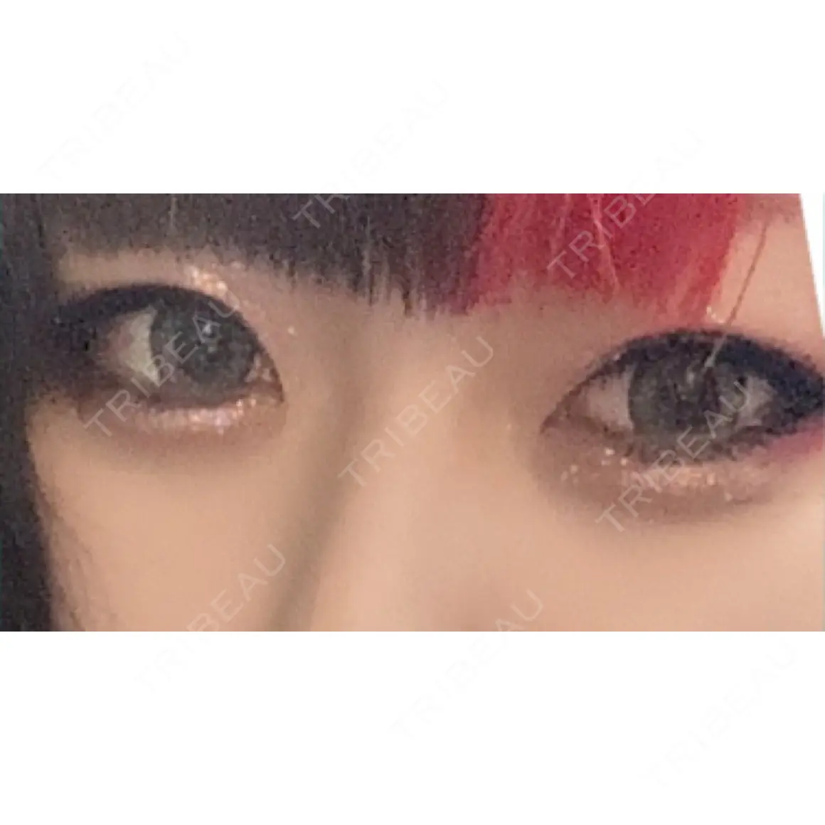 下まぶたの脂肪取り / 美容点滴・美容注射（美肌） / ヒアルロン酸溶解 品川美容外科 渋谷院（※品川スキンクリニック提携） AFTER