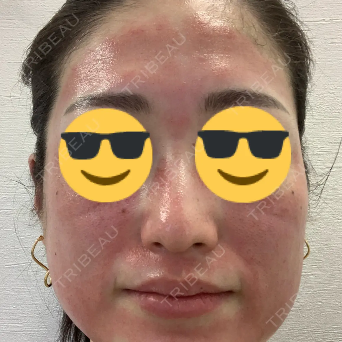 ダーマペン MSC LUNA CLINIC 渋谷院 DAY 0