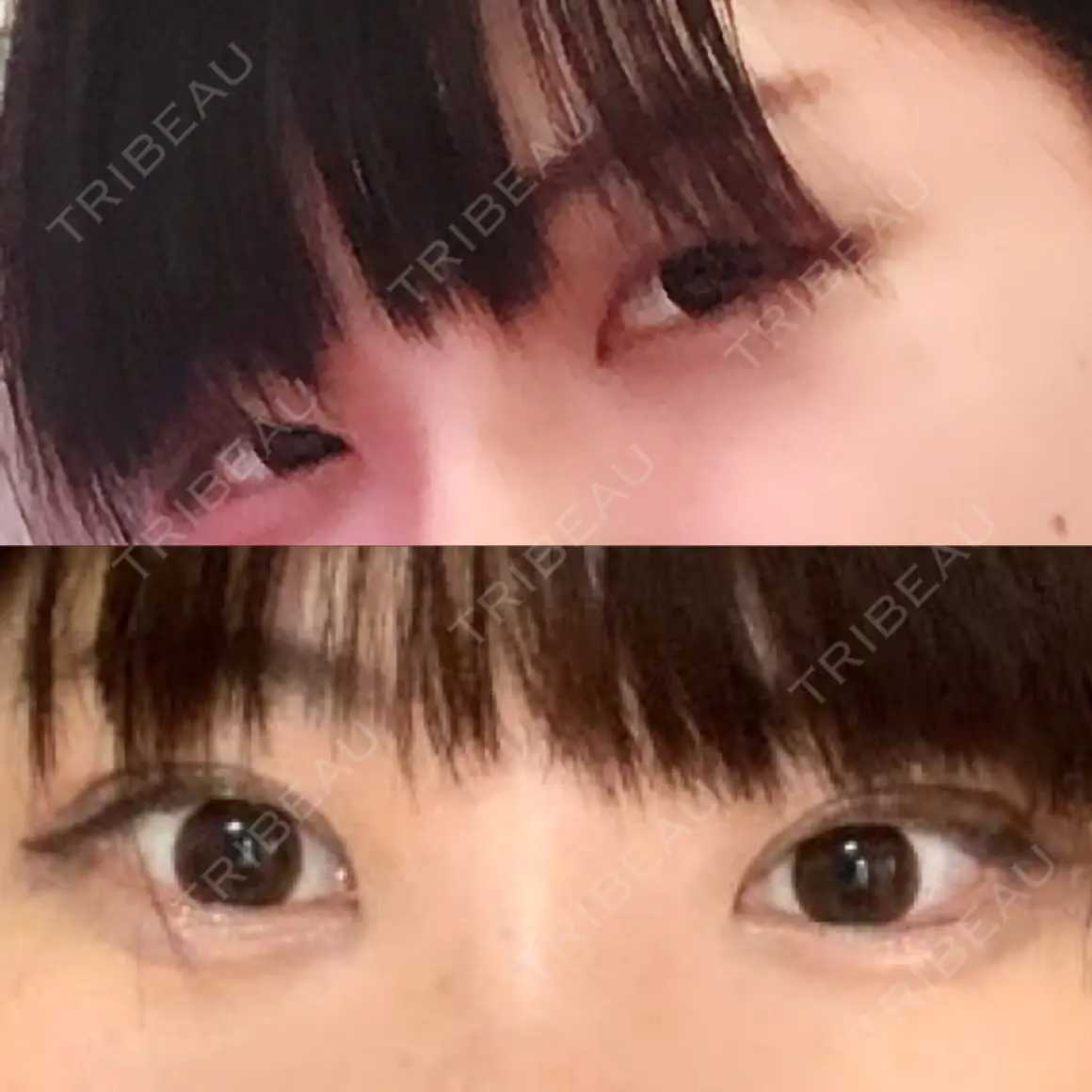 二重切開 / 骨切り（あご） / 骨削り（エラ） / 骨削り（頬） バノバギ整形外科 AFTER