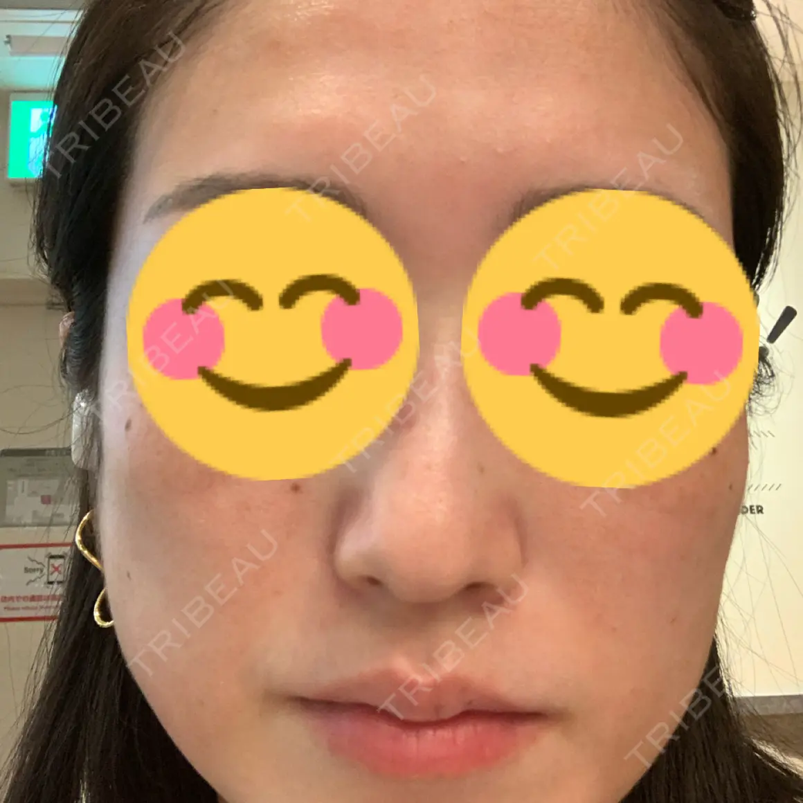 ダーマペン MSC LUNA CLINIC 渋谷院 AFTER