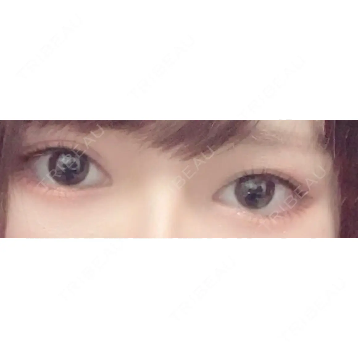 目頭切開 / 眼瞼下垂（切開） / 目尻切開 / 上まぶたの脂肪取り / タレ目形成・グラマラスライン（切開） BIANCA銀座 AFTER