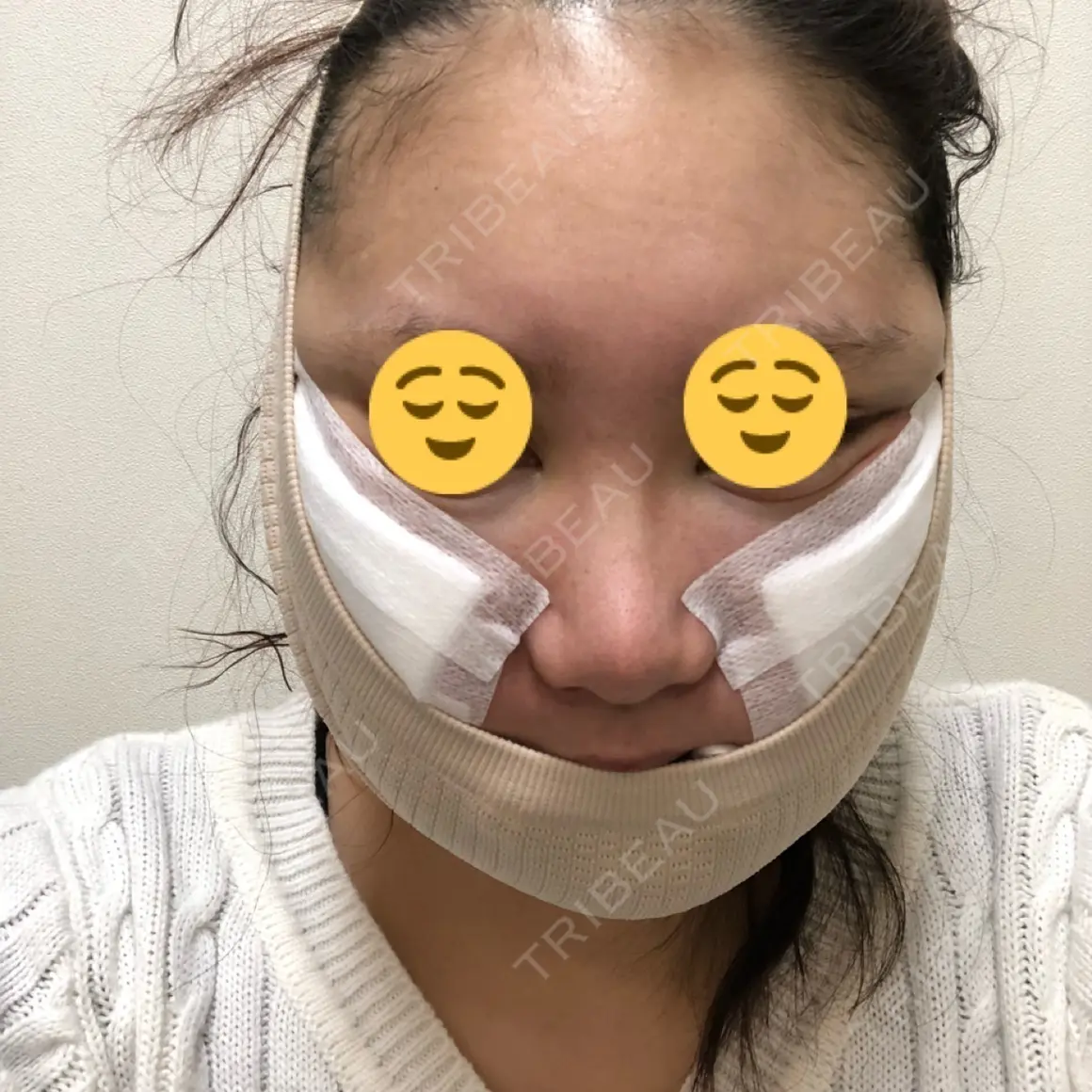 バッカルファット除去 / 脂肪吸引（顔） / その他（輪郭） フレッシュ整形外科 DAY 0