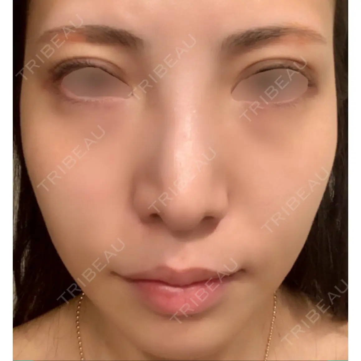 小鼻縮小（切開） / 骨切幅寄せ VENUS BEAUTY CLINIC　銀座院 AFTER