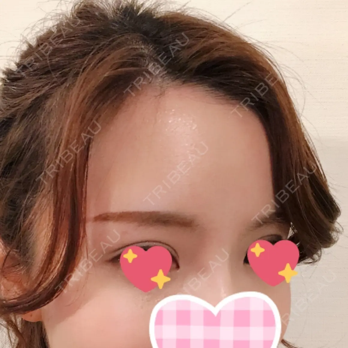 額を丸く / 脂肪注入（額） id（アイディ）美容外科 AFTER