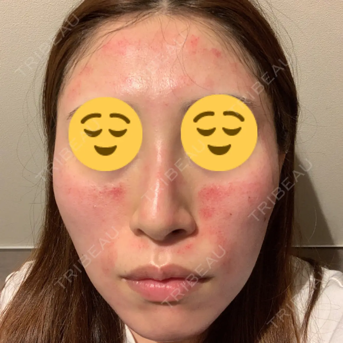 ダーマペン MSC LUNA CLINIC 渋谷院 DAY 0