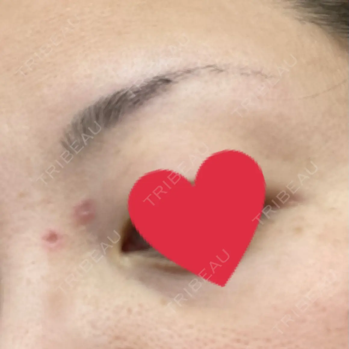 ほくろ・いぼ切除（肌） / ピコレーザートーニング（美白・肝斑） 聖心美容クリニック 札幌院 DAY 6