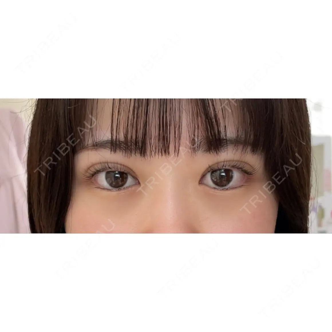 二重埋没 湘南美容クリニック 池袋東口院 DAY 1