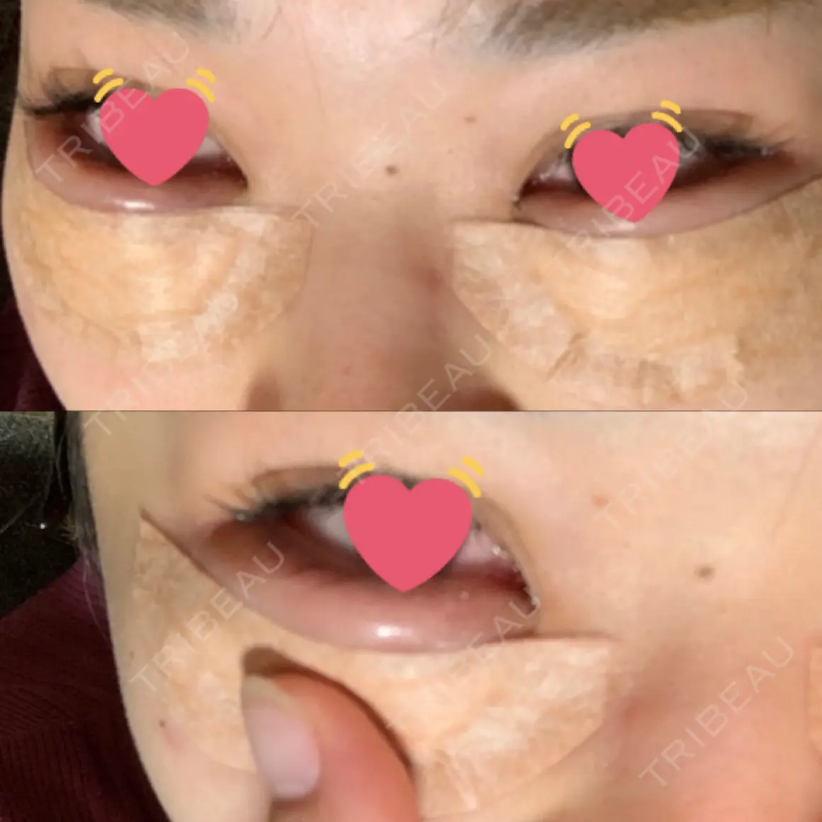 下まぶたたるみ取り 宇都宮竹内クリニック DAY 0