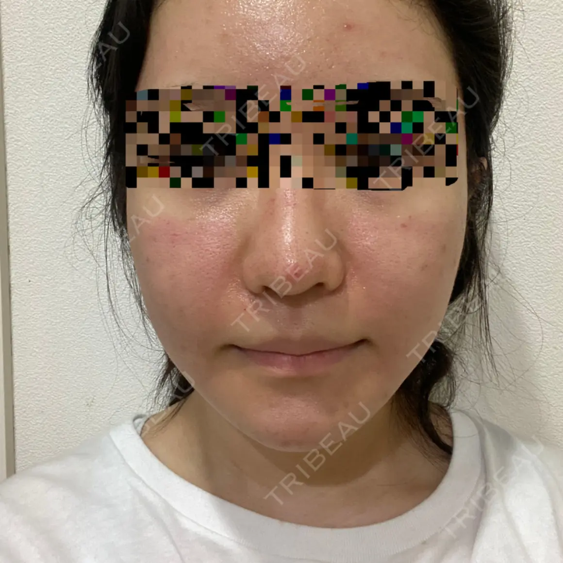 ダーマペン MSC LUNA CLINIC 渋谷院 DAY 0