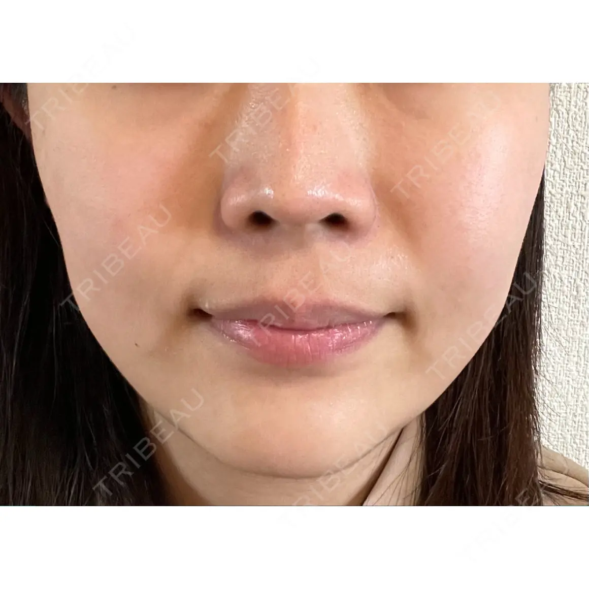 美容点滴・美容注射（美肌） 新宿ラクル美容外科クリニック 六本木院 AFTER