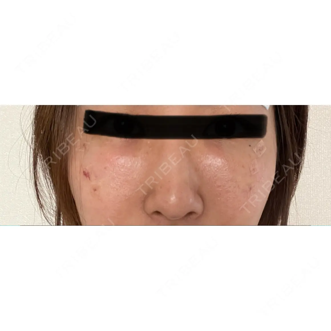 クマ治療 / 下まぶたたるみ取り / 下まぶたの脂肪取り / 脂肪注入（肌） アリエル美容クリニック 大宮院 DAY 6