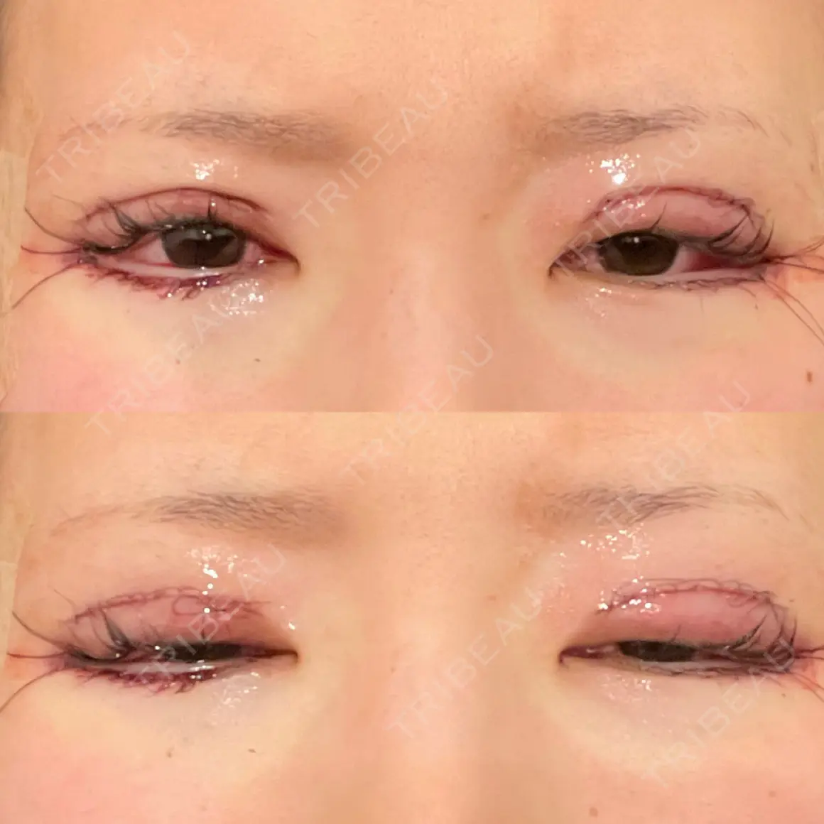 二重切開 / 眼瞼下垂（切開） / 目尻切開 / タレ目形成・グラマラスライン（切開） eクリニック 金沢本院 DAY 0