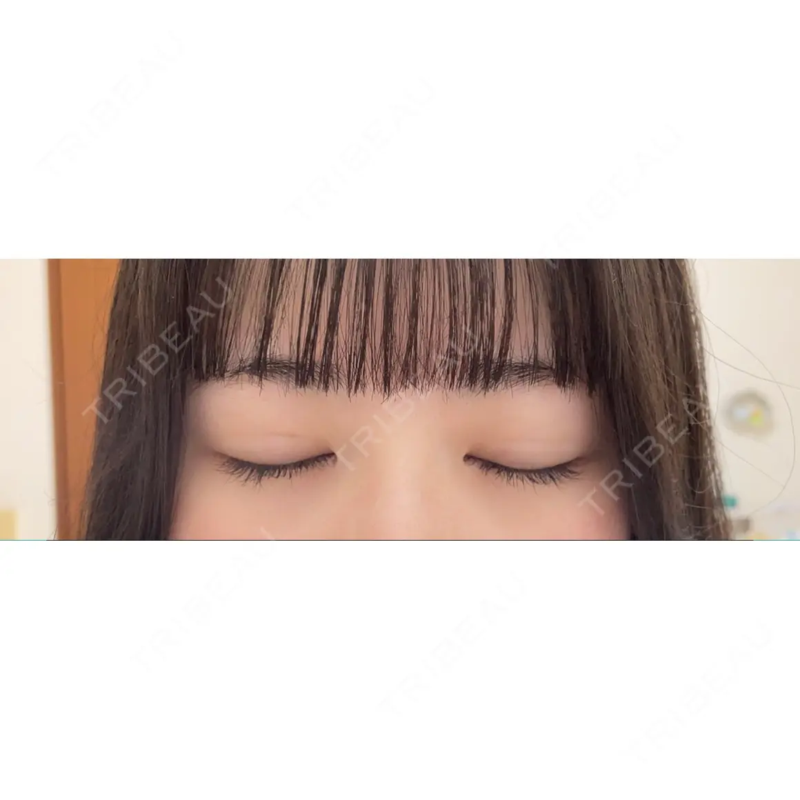 二重埋没 湘南美容クリニック 池袋東口院 AFTER