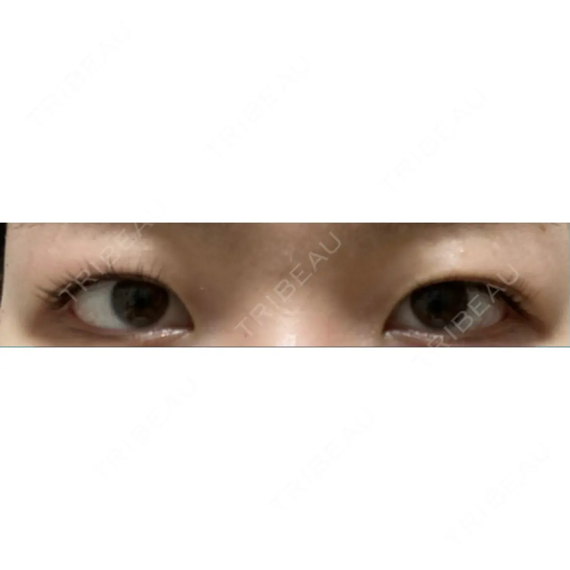 二重切開 オアシス美容外科 AFTER