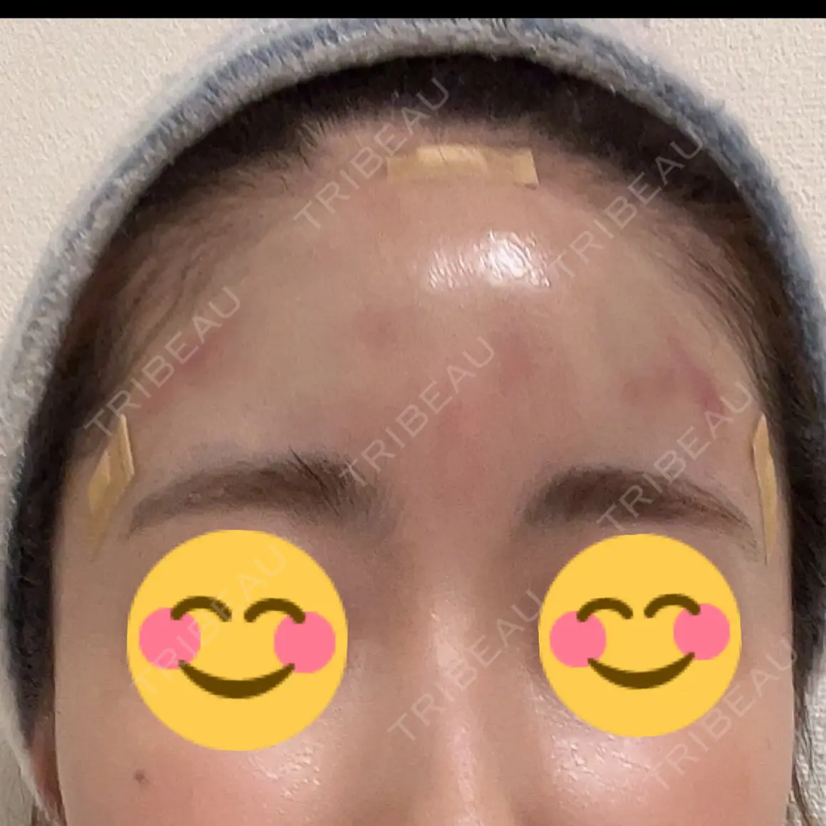 ヒアルロン酸注入（額） 藤・ナチュレ美容クリニック 恵比寿院 DAY 0