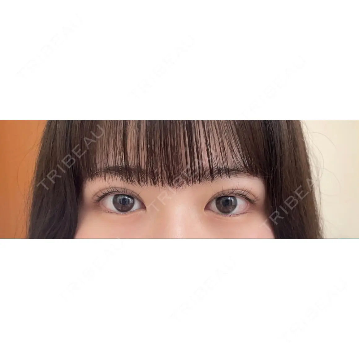 二重埋没 湘南美容クリニック 池袋東口院 AFTER