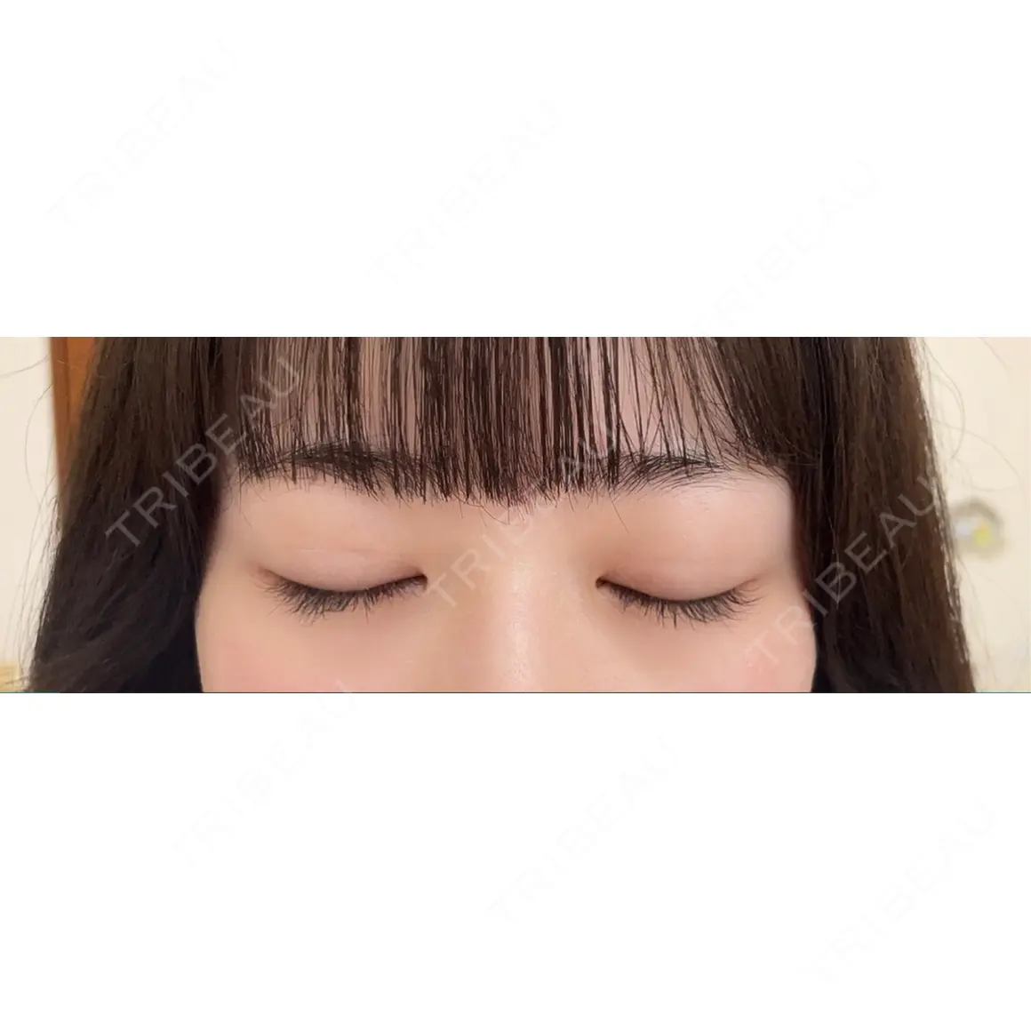 二重埋没 湘南美容クリニック 池袋東口院 AFTER