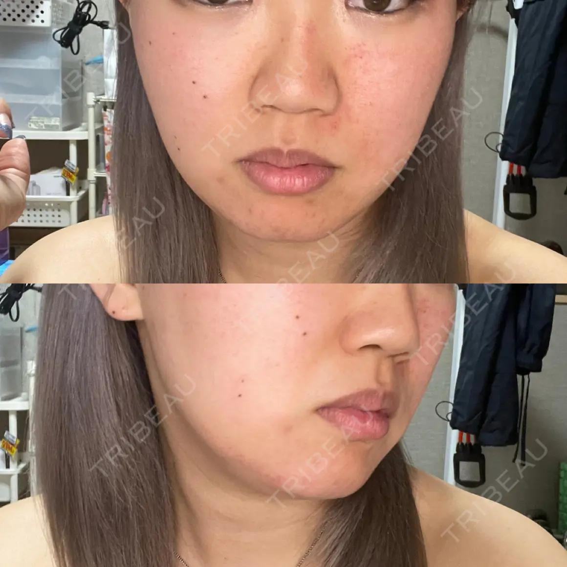ダーマペン MSC LUNA CLINIC 渋谷院 AFTER