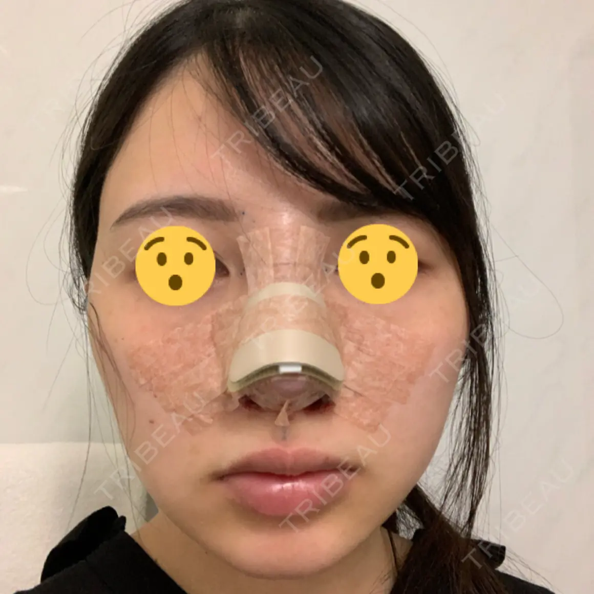 隆鼻術 / ワシ鼻修正・ハンプ切除 / その他（鼻） グローバルビューティークリニック 大阪院 DAY 0